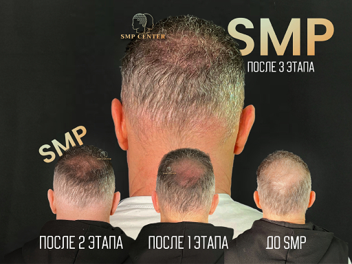 3 этапа процедуры